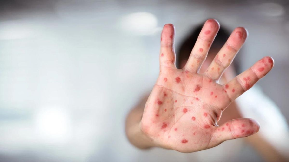 Bangladeş'te Kızamık Alarmı: 6 Haftada 227 Çocuk Hayatını Kaybetti!